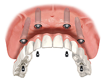 All Teeth Replacement
