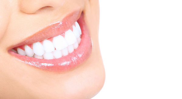 Veneers