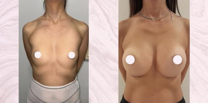 Breast augmentation — Before and after