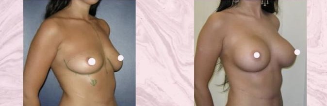 Breast augmentation — Before and after