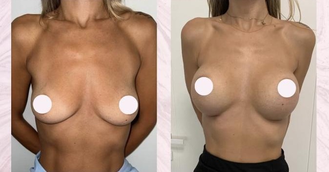Breast augmentation — Before and after