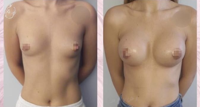 Breast augmentation — Before and after