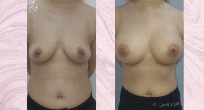 Breast augmentation — Before and after