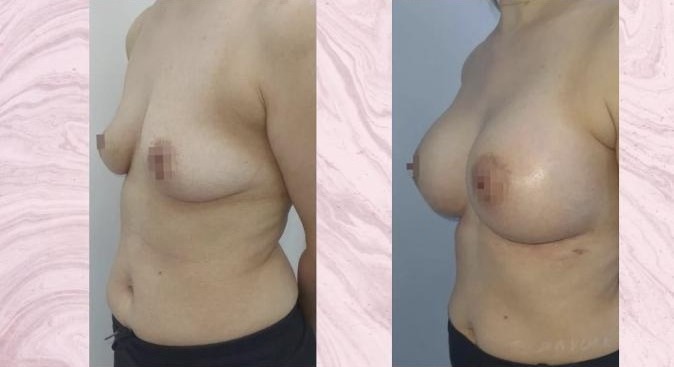 Breast augmentation — Before and after