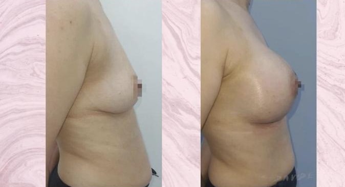 Breast augmentation — Before and after