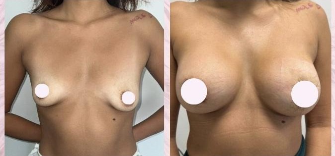 Breast augmentation — Before and after
