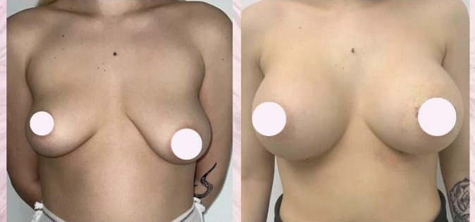 Breast augmentation — Before and after