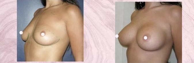 Breast augmentation — Before and after