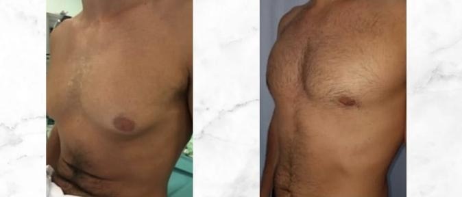 Gynaecomastia — Before and after
