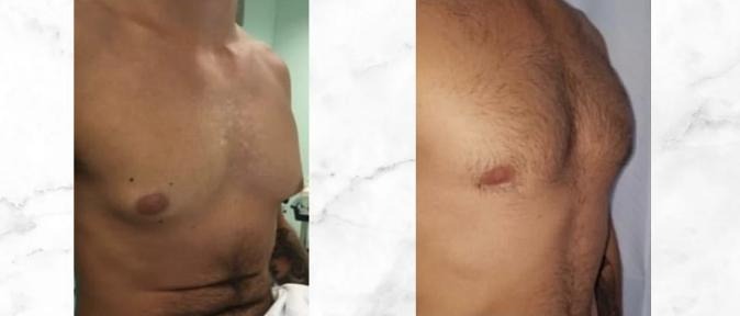 Gynaecomastia — Before and after