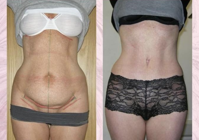 Tummy tuck with liposuction of flanks — Before and after