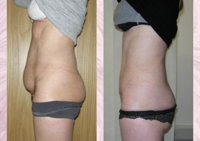 Tummy tuck with liposuction of flanks — Before and after