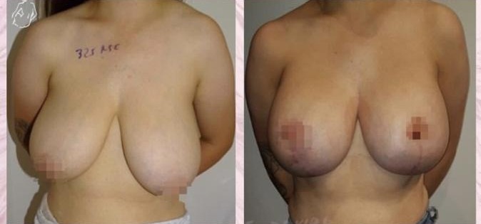 Breast augmentation with left periareola lift — Before and after