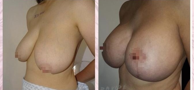 Breast augmentation with left periareola lift — Before and after